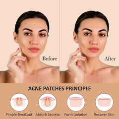 Rejusure Acne Patch | Waterproof Patches | Absorbs Pimple Overnight, Reduces Excess Oil | Acne Korean Spot Patch for Covering Zits and Blemishes | For All Skin Types | Men & Women - (72 Count)